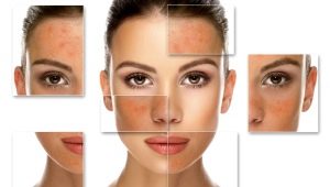 การปอกเปลือก Salicylic: คุณสมบัติและกฎการใช้งาน