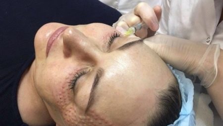 Papules pagkatapos ng biorevitalization: bakit lumilitaw ang mga ito at kailan sila nawawala?