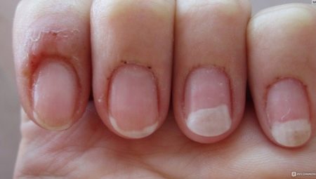 Allergy to gel polish: causes, symptoms and methods of treatment
