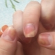 Onycholysis after applying gel polish